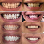 Noroos Dentite® – Suero Bucal Re-mineralizante con Nano-Hidroxiapatita